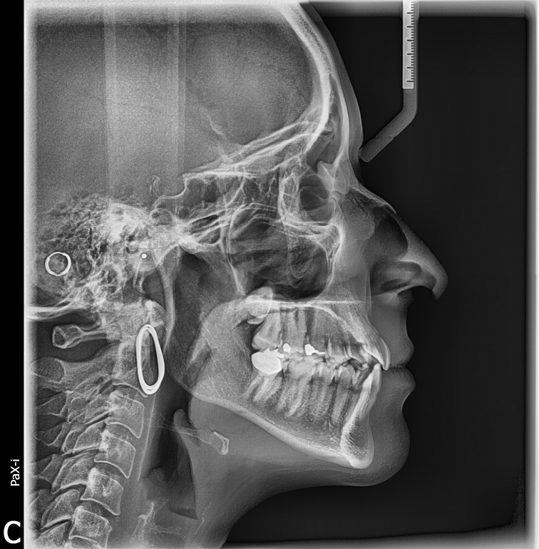 Vatech Pax-i OPG s Cephalem