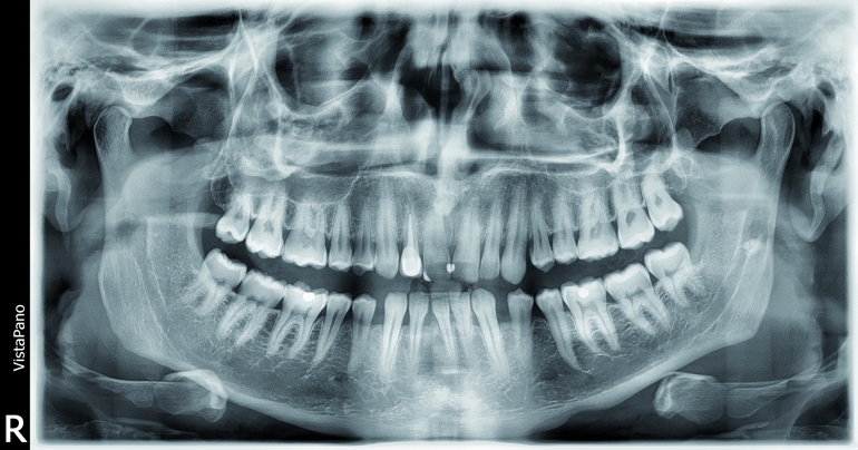 OPG rentgen VistaPano od Dürr Dental, r.v. 2017, rok záruka! OPG rentgen VistaPano od Dürr Dental, r.v. 2017, rok záruka!
