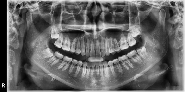 OPG Vatech Pax-i, TOP stav, aktuální model, záruka.