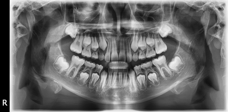 OPG Vatech Pax-i, TOP stav, aktuální model, záruka.