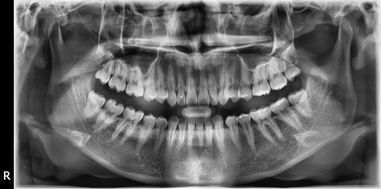 OPG Vatech Pax-i, TOP stav, aktuální model, záruka.