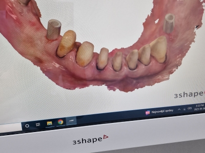 3Shape TRIOS 3 - intraorální skener