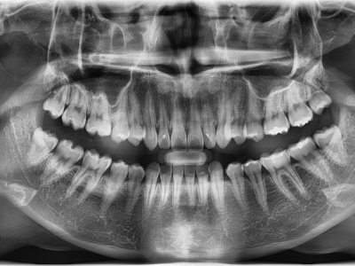 OPG Vatech Pax-i, TOP stav, aktuální model, záruka.
